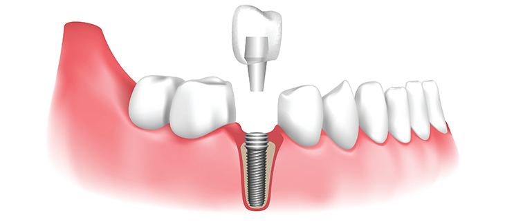 Dental Implant Aftercare & Maintenance