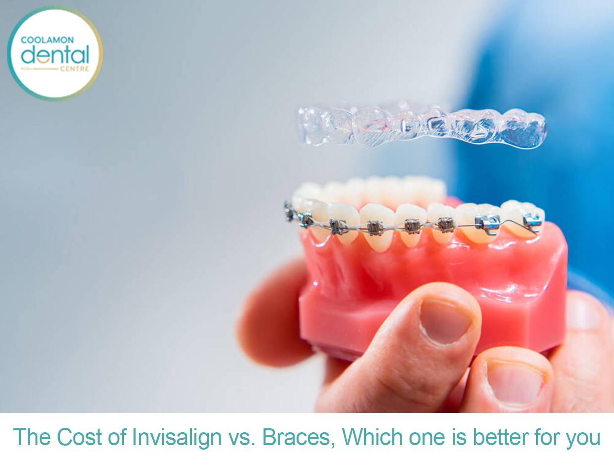 Invisalign Vs Braces - Cost, Pros & Cons - Which Is Better?