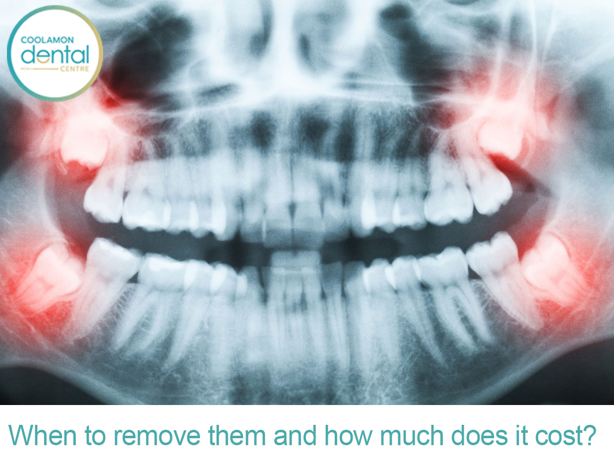 Wisdom Teeth Removal Surgery – Cost And Procedures